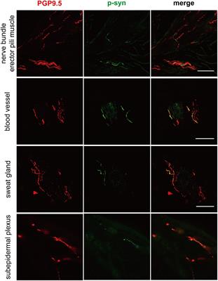 Peripheral cutaneous synucleinopathy characteristics in genetic Parkinson’s disease